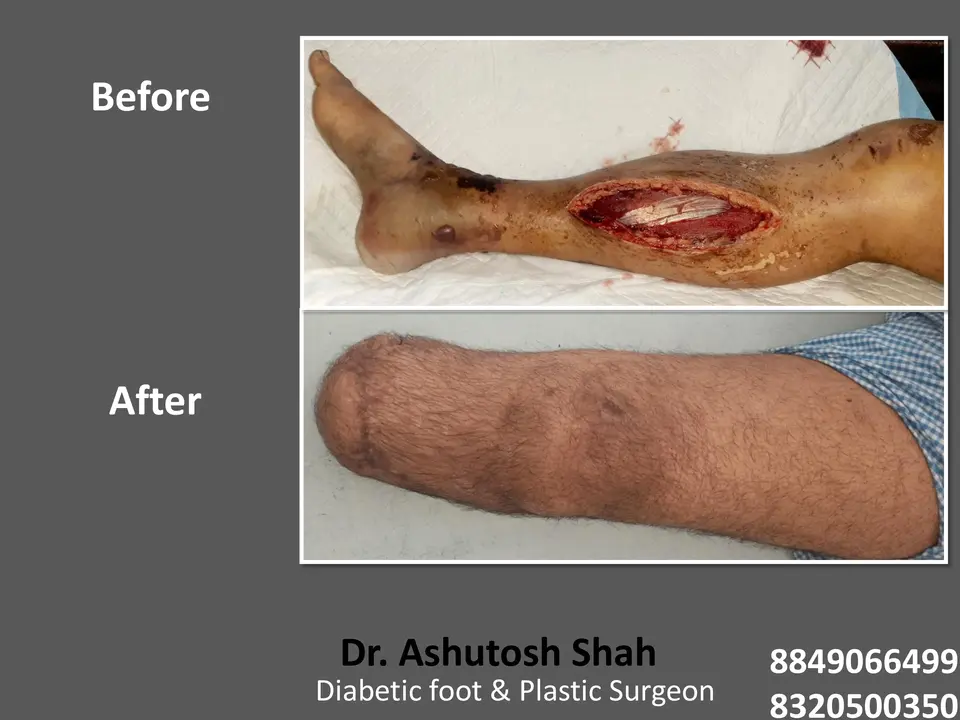 Diabetic Foot  PPT sunita.pptx-61.webp